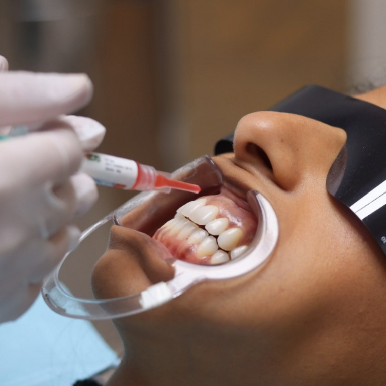 Blanchiment des dents