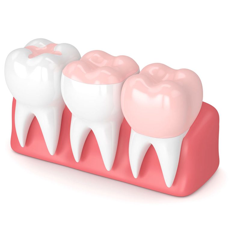 Traitement porodontie